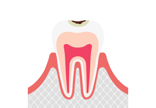 虫歯の進行c1