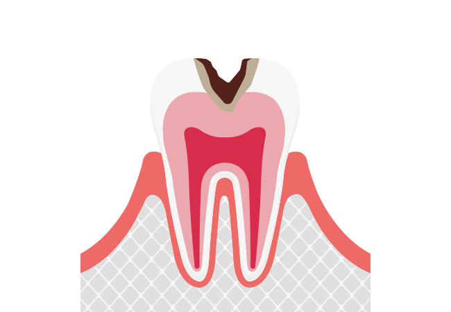 虫歯の進行c2