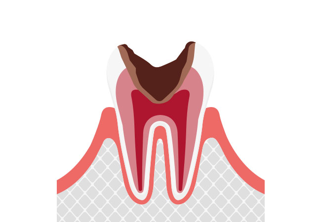 虫歯の進行c3