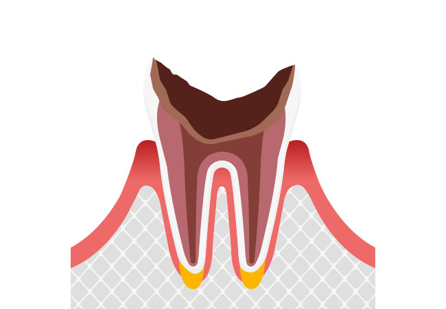 虫歯の進行c4
