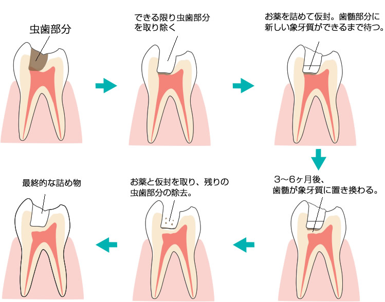 神経温存療法