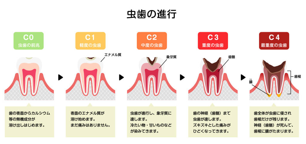 虫歯の進行